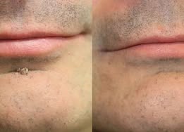 ✨Nuvopaw®2-in-1 Microneedle & Hydrocolloid Patch🍀| Removes Raised Moles, Acne, Flat Warts & Skin Tags | Helps Improve Wrinkles, Scars & Blemishes | Invisible Patches for Face & Body