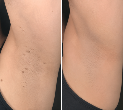 ✨Nuvopaw®2-in-1 Microneedle & Hydrocolloid Patch🍀| Removes Raised Moles, Acne, Flat Warts & Skin Tags | Helps Improve Wrinkles, Scars & Blemishes | Invisible Patches for Face & Body