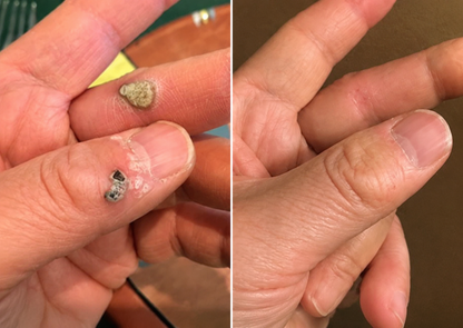 ✨Nuvopaw®2-in-1 Microneedle & Hydrocolloid Patch🍀| Removes Raised Moles, Acne, Flat Warts & Skin Tags | Helps Improve Wrinkles, Scars & Blemishes | Invisible Patches for Face & Body